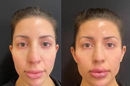 Best Fillers in Dubai