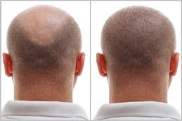 FUE Hair Transplant Cost in Dubai Abu Dhabi