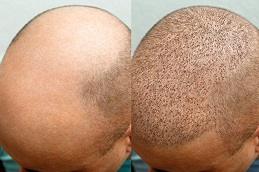 FUE Hair Transplant in Dubai Abu Dhabi