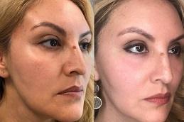 Facial Treatment Cost in Dubai Abu Dhabi