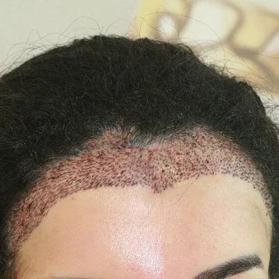 Female Hair Transplant in Dubai & Abu Dhabi