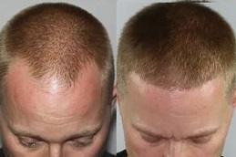 Fue Hair Transplant Clinic in Dubai