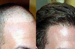 Fue Hair Transplant in Dubai