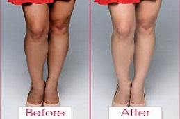 Full Body Whitening leg Before & After clinic in Dubai