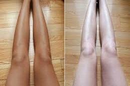 Full Body Whitening leg Before & After in Dubai