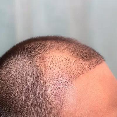 Hair Grafting Near Me Dubai, UAE