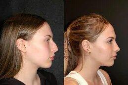 Jawline Fillers before & after Dubai