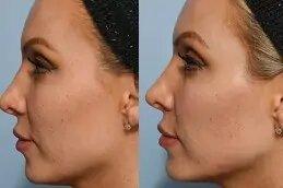 Jawline-Fillers-before-after