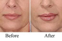 Juvederm Fillers Clinic in Dubai