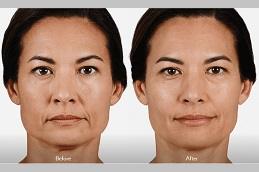 Juvederm Fillers Cost in Dubai & Abu-Dhabi