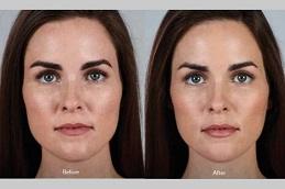 Juvederm Fillers in Dubai Abu-Dhabi