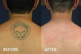 Permanent Laser Tattoo Removal Dubai