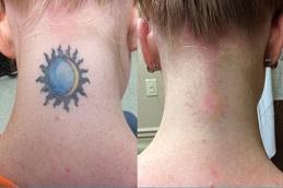 Best Permanent Laser Tattoo Removal Dubai