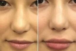 Best Lip Fillers Injections 