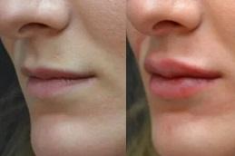 Best Lip Fillers Injections