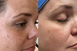 Microneedling Treatment Clinic in Dubai