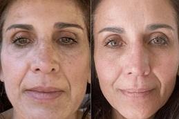 Microneedling Treatment In Dubai Abu Dhabi