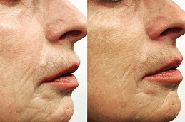 Microneedling Treatment in Dubai