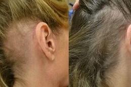 PRP Hair Treatment Clinic in Dubai UAE