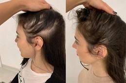 PRP Hair Treatment Cost in Dubai Abu Dhabi