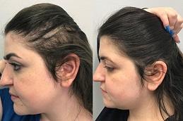 PRP Hair Treatment in Dubai & Abu Dhabi