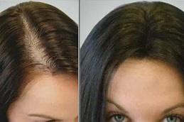 PRP Hair Treatment in Dubai