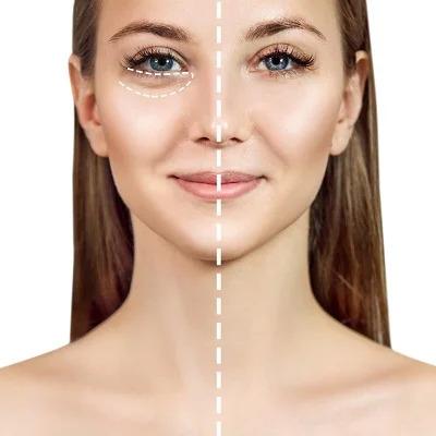 PRP Injections for Under Eye Bags Dubai & Abu Dhabi