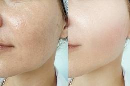 Permanent Skin Whitening Treatment Cost in Dubai Abu Dhabi 1