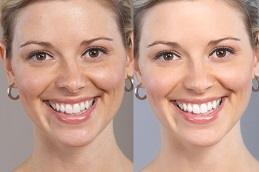 Permanent Skin Whitening Treatment in Dubai Abu Dhabi 1