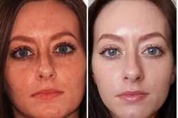 Best Pico Laser Treatment in Dubai