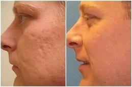 Pico Laser Treatment in Dubai