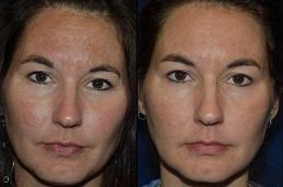 Best Pico Laser Treatment in Dubai