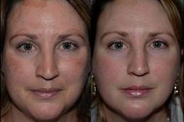 Pico Laser Treatment