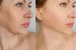 Results of Botox Injection clinic Dubai