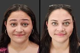 Results of Botox Injections clinic in Dubai