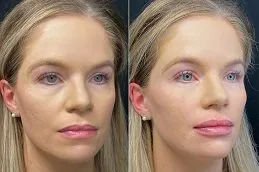 Results of Dermal Fillers Injection in Dubai