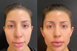 Results of Dermal Fillers Injection