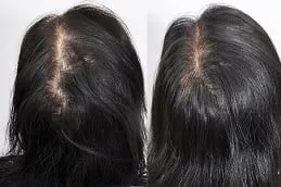 Results of Hair Transplant Clinic in Dubai