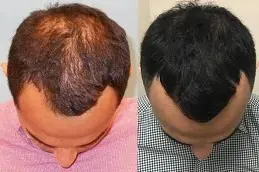 Results of Hair Transplant in Dubai;