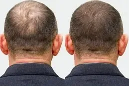 Results of Hair Transplant in Dubai