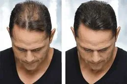 Results of Hair Transplant in Dubai;