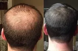 Results of Hair Transplant in Dubai;
