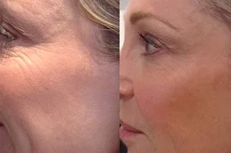 Results of Sunekos Injections clinic in Dubai