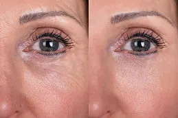 Results of Sunekos Injections in Dubai