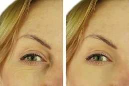 Results of Sunekos Injections in Dubai,.