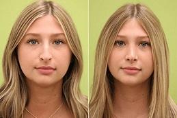 Best Rhinoplasty in Dubai