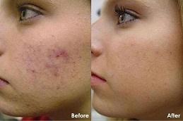 Superficial Chemical Peels Cost in Dubai Abu Dhabi