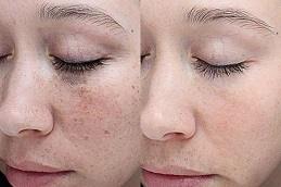 Superficial Chemical Peels in Dubai Abu Dhabi