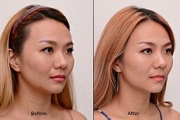 Ultherapy Cost in Dubai Abu Dhabi