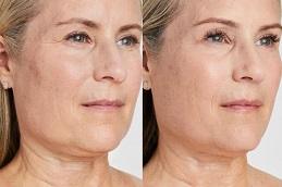 Ultherapy Treatment Cost in Dubai Abu Dhabi